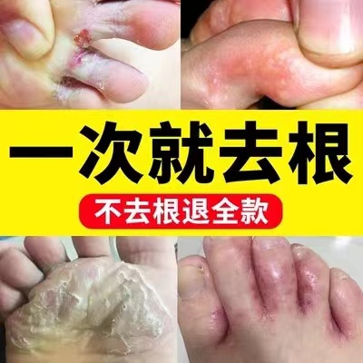 脚气药根治止痒真菌感染