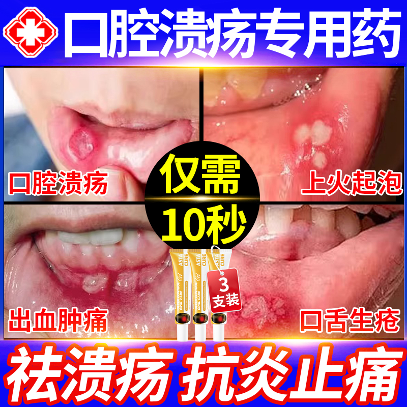 口腔溃疡专用药一点灵